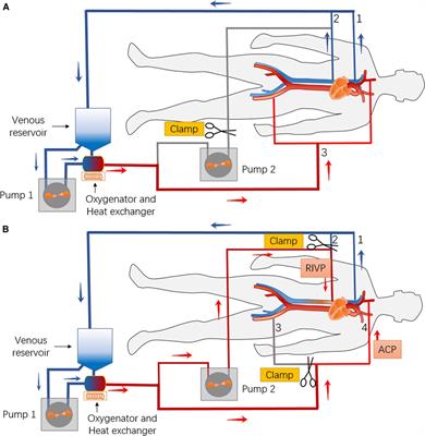 Cardiopulmonary bypass for total aortic arch replacement surgery: A review of three techniques